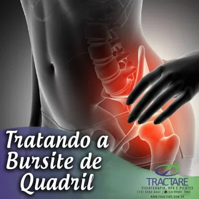 Imagem educativa sobre bursite de quadril e fisioterapia em Santos